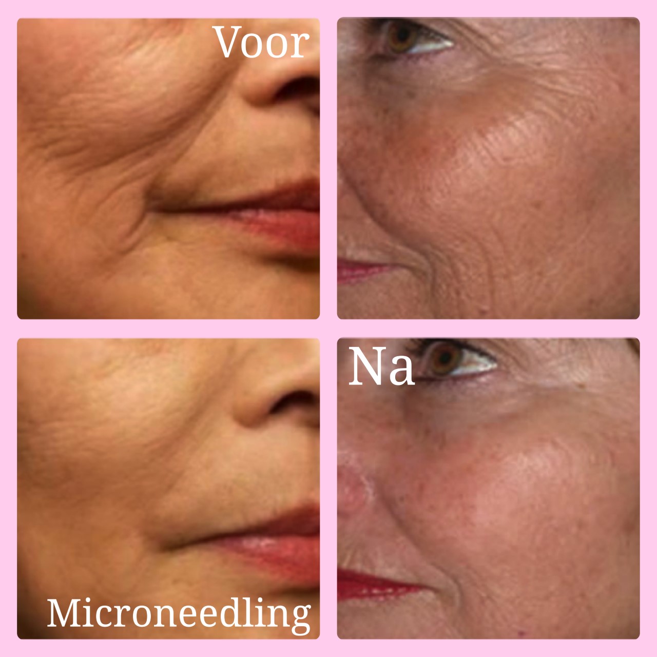 Microneedling | Huidsalon Beauty Style